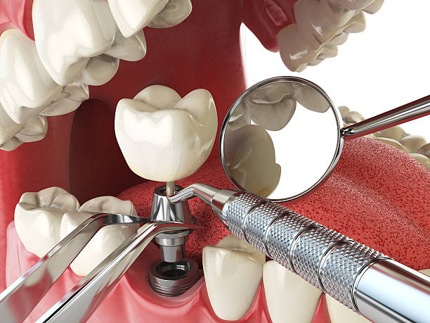 Best Emergency Wisdom Teeth Removal in Rosemont, IL